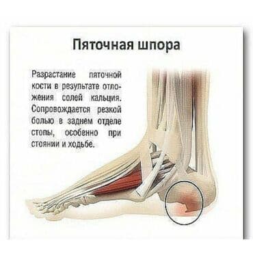 фиксатор на голеностоп: Подпяточник при шпоре ⠀ Из натуральной кожи для облегчения болевых — 6
