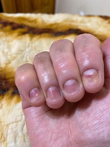 пятка: Подолог Бишкек Подолог, Бишкек, вросший ноготь, трещины на пятках — 2