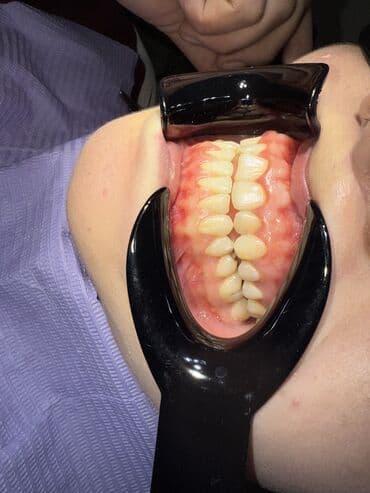 реставрация 4 зуба: Врачи | Стоматолог | Диагностика — 4