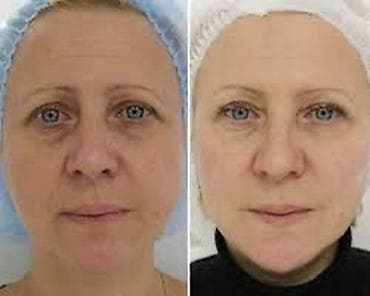 Косметология, Разглаживание и коррекция морщин, Консультация