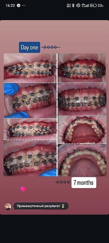 лечение гемороя: 1)Профессиональная 3-х этапная гигиена полости рта (ультразвук — 5