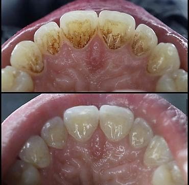 клиника дентомакс бишкек: Лечение кариеса 
Фотопломба
Чистка
Удаление 
Протезирование — 7