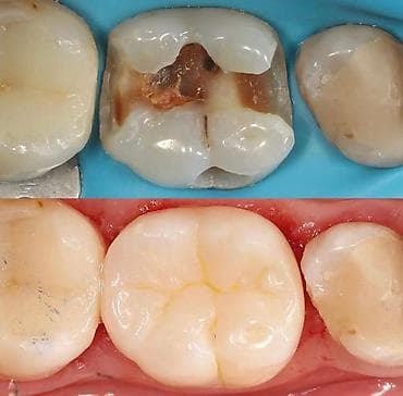 клиника дентомакс бишкек: Лечение кариеса 
Фотопломба
Чистка
Удаление 
Протезирование — 1