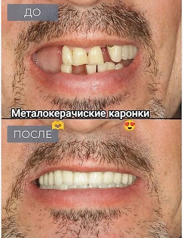 протезы для ног: Съёмные зубные протезы под ваши задачи - Вакуумные протезы: плотная — 5