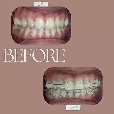 лечение гемороя: 1)Профессиональная 3-х этапная гигиена полости рта (ультразвук — 6