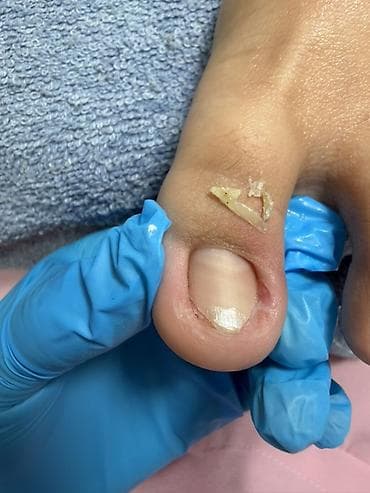 удаление папилом: Коррекция вросших ногтей, Педикюр, Одноразовые расходные материалы — 6