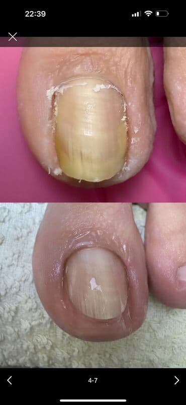📍 РЕЗУЛЬТАТ ДО/ПОСЛЕ Работа с ногтевой пластиной, поражённой грибком и