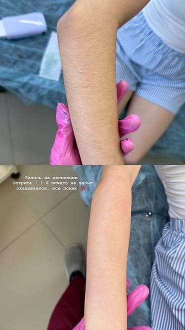 депиляция аппарат купить: Депиляция для мужчин Профессиональное удаление нежелательных волос — 1