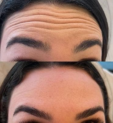 ботекс лица: Косметология, Ботулинотерапия, Сертифицированный косметолог — 4