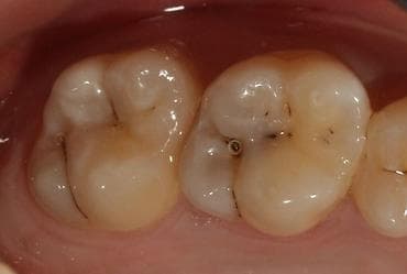 лечение гемороя: 1)Профессиональная 3-х этапная гигиена полости рта (ультразвук — 3