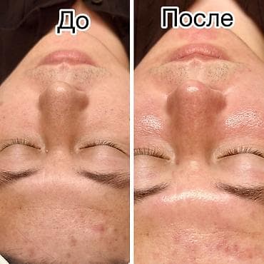 чай для похудения: Лазерная эпиляция в Бишкеке - Диодный лазер премиум‑класса последнего — 2