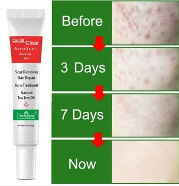 крем для отбеливания кожи и устранения пигментных пятен: Крем для лица Quick Clear с масло чайного дерева. От акне, шрамов — 1