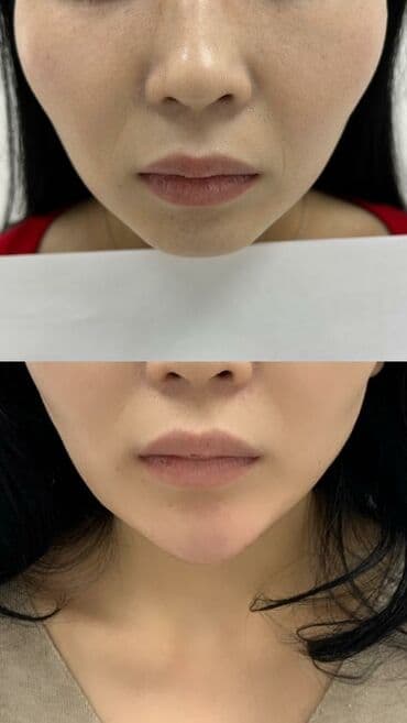 слива ферментированная капсула для похудения отзывы: Косметология, Биоревитализация, Контурное моделирование, Лечение угревой болезни, Сертифицированный косметолог — 3