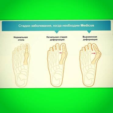 фиксатор пальца: Корректоры для большого пальца ноги от вальгусной деформации(косточки — 11
