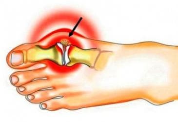 Корректоры от косточки на ноге! Ночные и дневные Турция, Китай