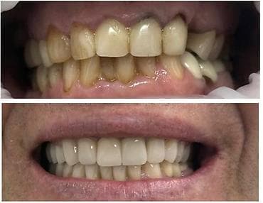 лечения: Стоматологические услуги - Лечение кариеса: японская пломба — 1500 — 7