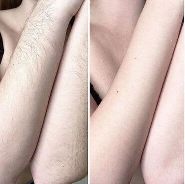 хиджама кровопускание: Шугаринг!!!! Я Бегайым!🌸 мастер с 5️⃣ летним стажем и с медицинским — 2