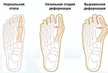 накладки для ног: Корректоры для большого пальца ноги от вальгусной деформации(косточки — 1