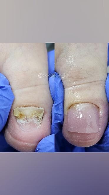 Протезирование ногтей 
создаём красоту на долгое время!
По записи