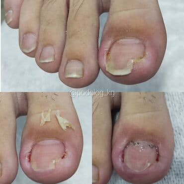 сколько стоит обучение на маникюр: Коррекция вросших ногтей, Услуги подолога, Педикюр, Одноразовые расходные материалы, Консультация — 8