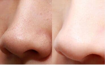 Киреге берилүүчү кийимдер: Скруббер для кожи инструмент для удаления угрей, очистка пор кожи — 6