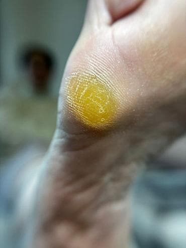 мед обувь: ПОДОЛОГИЧЕСКИЕ УСЛУГИ - Аппаратный медицинский педикюр и маникюр для — 5