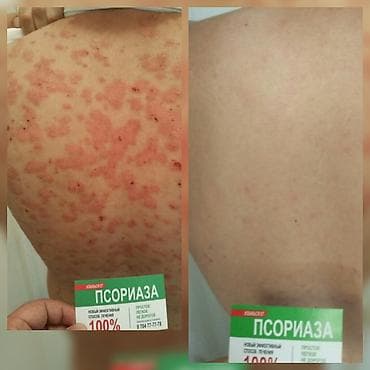 мазь: Здравствуйте! Найден эффективный способ от Псориаза. Я сам болею этой — 3