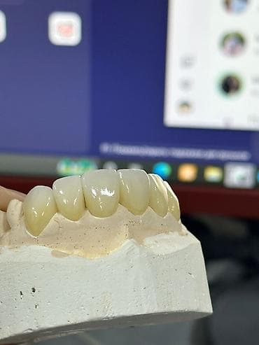 купить на крышу профнастил: Керамические коронки/виниры для передней группы зубов - Изготовление — 1