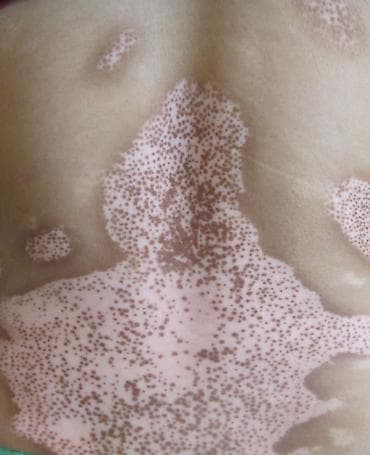 Раствор от витилиго TOPFOND, 30 мл. Описание: - Средство наружного