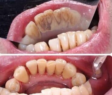 беремен: Профессиональная гигиена полости рта: снятие зубного камня и — 2