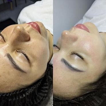 Косметология, Терини тазалоо, Консультация — 4