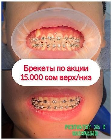 Резюмелер: Брекеты за 15 000 сом. В чем подвох?» Ни в чем. Просто лечение на — 1