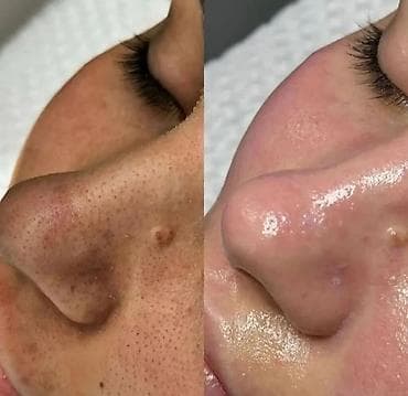 для кожа: Профессиональная чистка кожи лица (нос, Т-зона) с видимым эффектом — 3