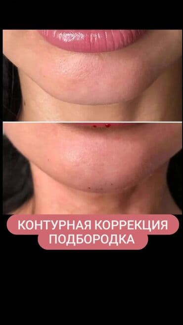 нейлоновые зубные протезы в бишкеке цены: Косметология, Ботокс, Биоревитализация, Ботулинотерапия, Консультация, Гипоаллергенные материалы, Сертифицированный косметолог — 6