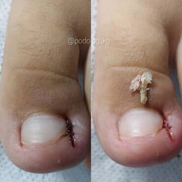 сколько стоит обучение на маникюр: Коррекция вросших ногтей, Услуги подолога, Педикюр, Одноразовые расходные материалы, Консультация — 2