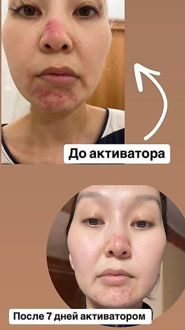 Продается новый Активатор клеток WHIEDA (FOHERB) Для лечение псориаза — 4