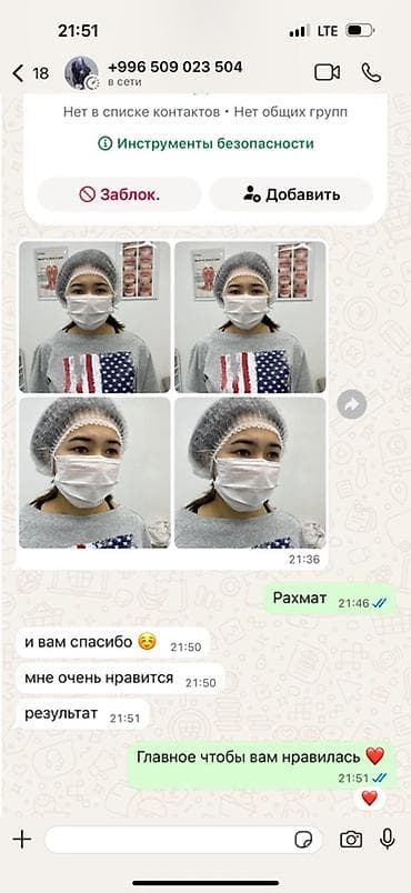 ihone x: Нитевая блефаропластика «Сингапури» без операции ✨ Процедура — 3