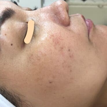 хиджама кровопускание: Косметология, Чистка кожи, Биоревитализация, Пилинг, Сертифицированный косметолог, Гипоаллергенные материалы, Консультация — 7