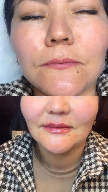 слива ферментированная капсула для похудения отзывы: Косметология, Биоревитализация, Контурное моделирование, Лечение угревой болезни, Сертифицированный косметолог — 7