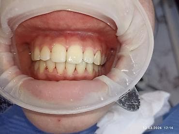 анатомический: Ортодонтическое лечение: установка брекет‑системы на нижнюю челюсть - — 4