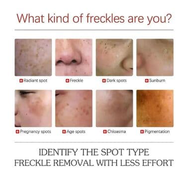 эффективный отбеливающий крем для зоны бикини в аптеке: США Крем отбеливающий для удаления мелазмы осветления кожи удаления — 12