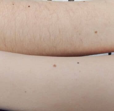 хиджама кровопускание: Шугаринг!!!! Я Бегайым!🌸 мастер с 5️⃣ летним стажем и с медицинским — 4