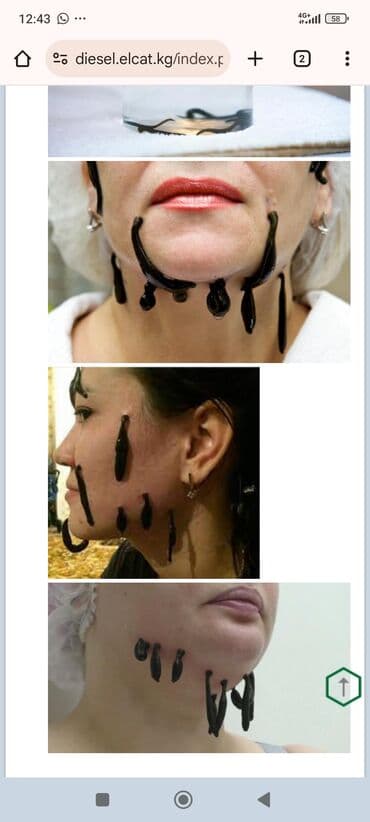 хиджама кровопускание: Врачи | Гирудотерапевт | Лечение пиявками — 9