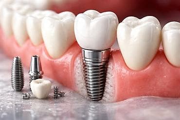 патолок уста: Dentium SuperLine — стоматологические импланты.Производство Южная — 9