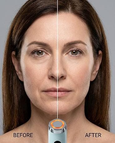 ring light: Аппараты для домашнего лифтинга от mommy care: PentaPrime и V-THERA — 7