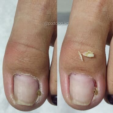 сколько стоит обучение на маникюр: Коррекция вросших ногтей, Услуги подолога, Педикюр, Одноразовые расходные материалы, Консультация — 7