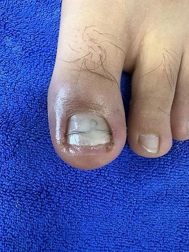 удаление папилом: Коррекция вросших ногтей, Педикюр, Одноразовые расходные материалы — 3