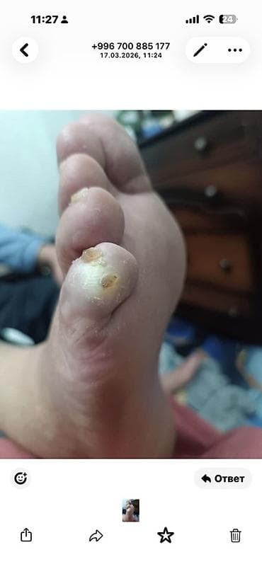 удаление папилом: Коррекция вросших ногтей, Педикюр, Одноразовые расходные материалы — 4