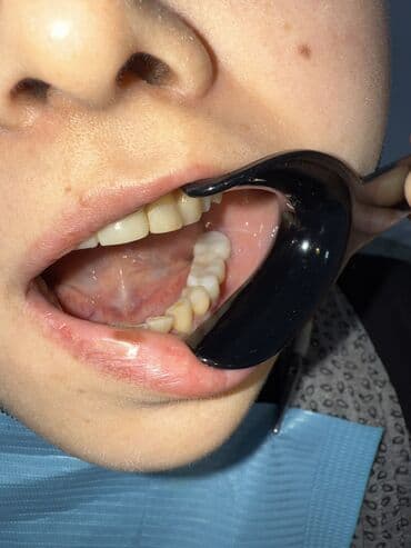 реставрация 4 зуба: Врачи | Стоматолог | Диагностика — 6