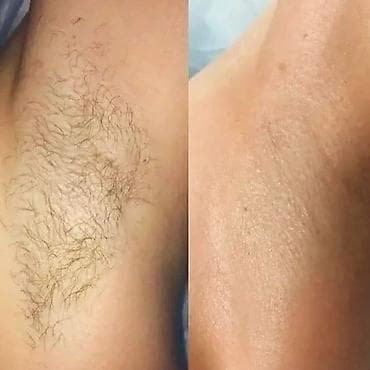 step 2: Шугаринг и восковая депиляция #депиляция — 1